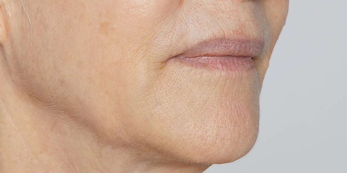 Clinical study after: Close-up of lower face showing fine lines and textured skin around the mouth and jaw
