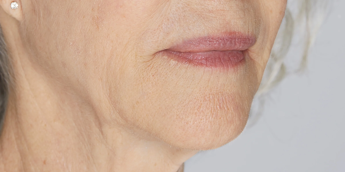 Clinical study before: Close-up of lower face showing wrinkles and crepey skin around mouth and jawline